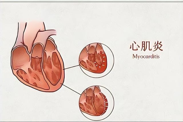 心肌炎的癥狀有哪些？心肌炎的主要變現癥狀有啥？